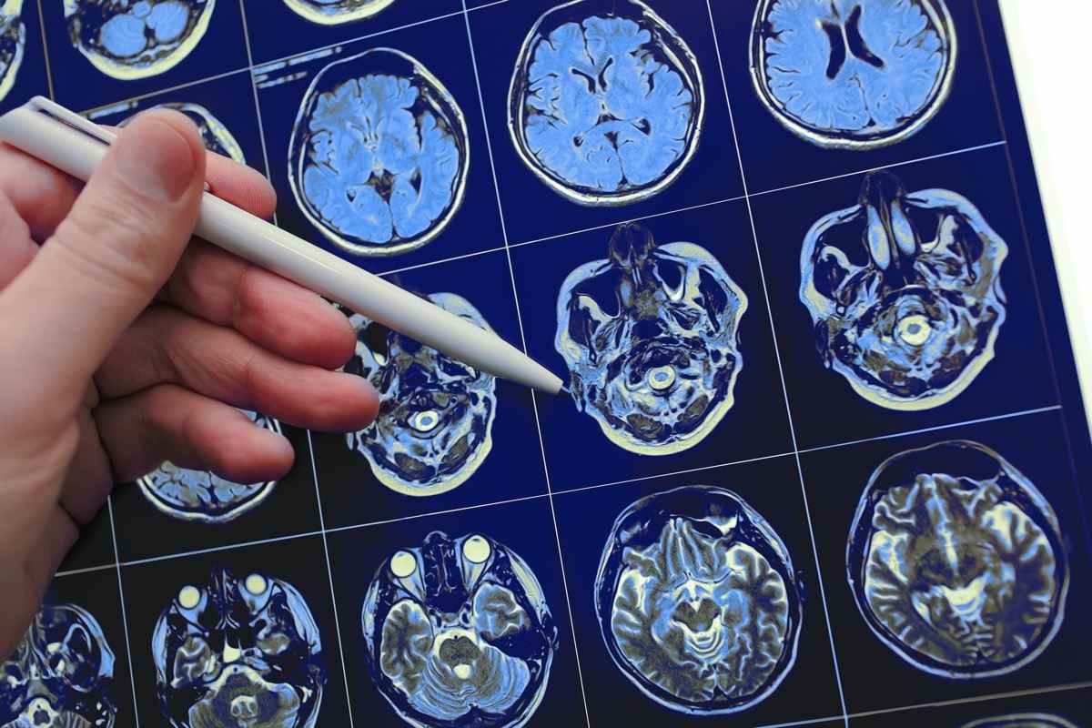 Arzt, der mit Stift auf das Gehirnpoblem auf das Ergebnis der MRT-Studie zeigt