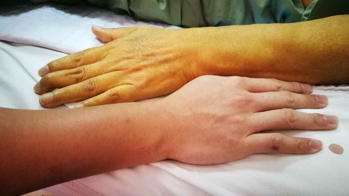 Gelbsuchtpatient mit gelblicher Verfärbung der Haut im Vergleich zu normaler Hautfarbe.