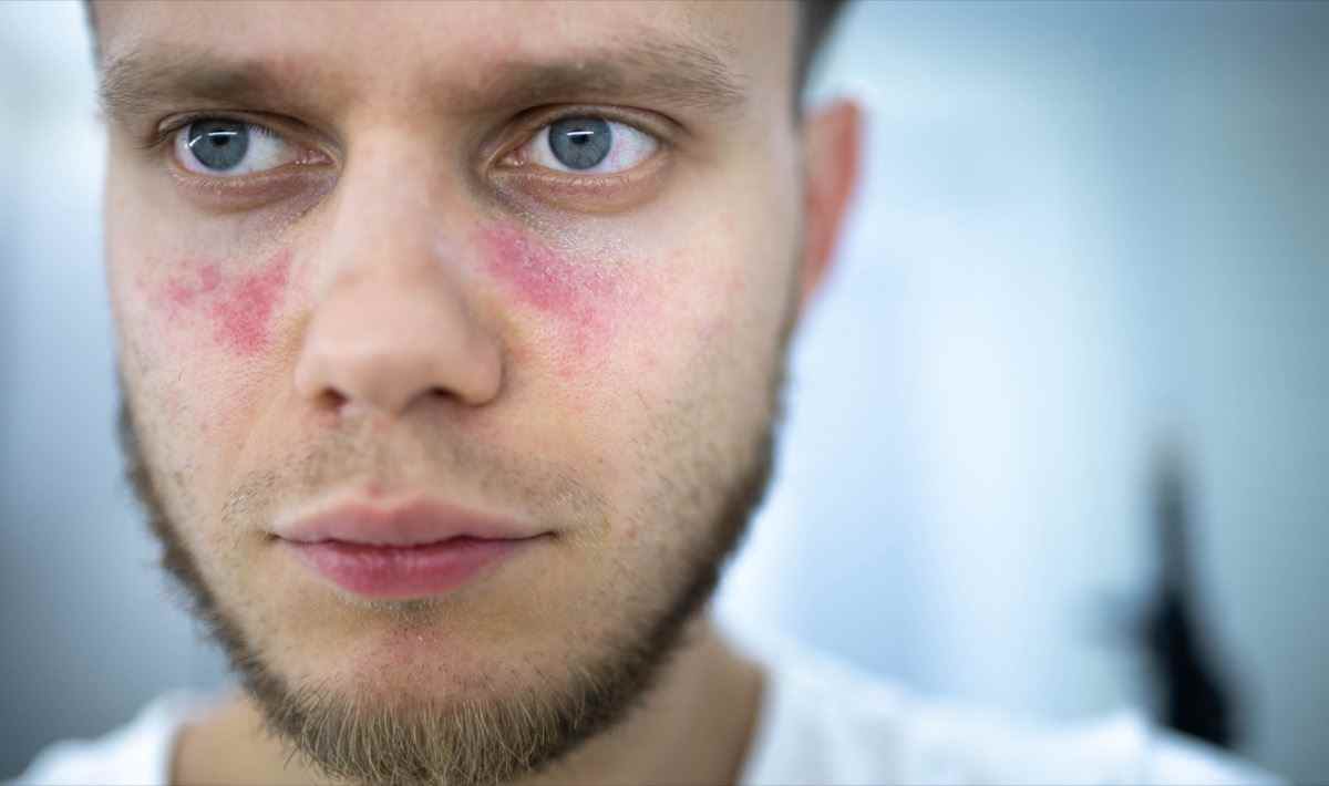 Rötungen im Gesicht, ein junger Mann ist an systemischem Lupus erythematodes erkrankt
