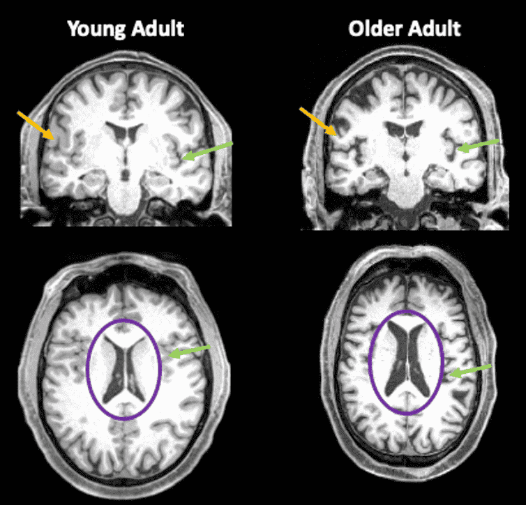 Gehirnscans von einer Person in den 30ern und einer Person in den 80ern, die ein reduziertes Gehirnvolumen im Gehirn älterer Erwachsener zeigen