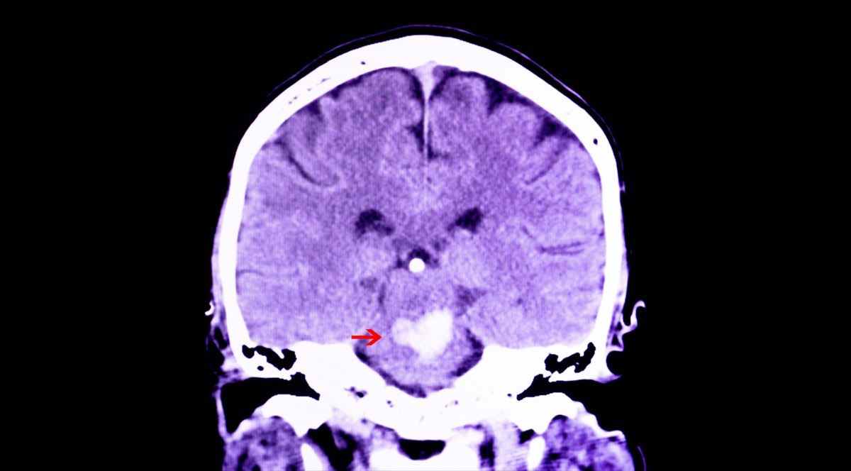 CT-Scan des Gehirns eines Patienten mit intrakranieller Blutung