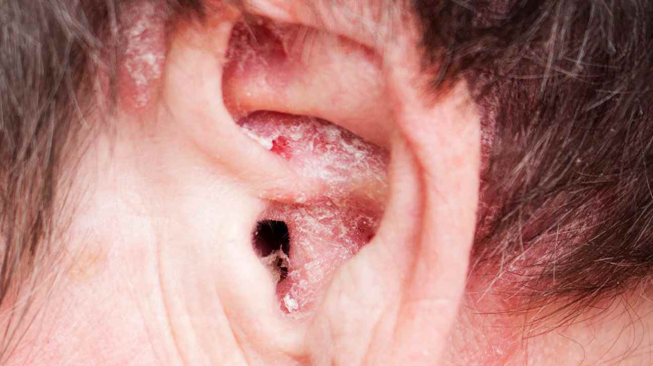Schuppenflechte der Kopfhaut um das Ohr