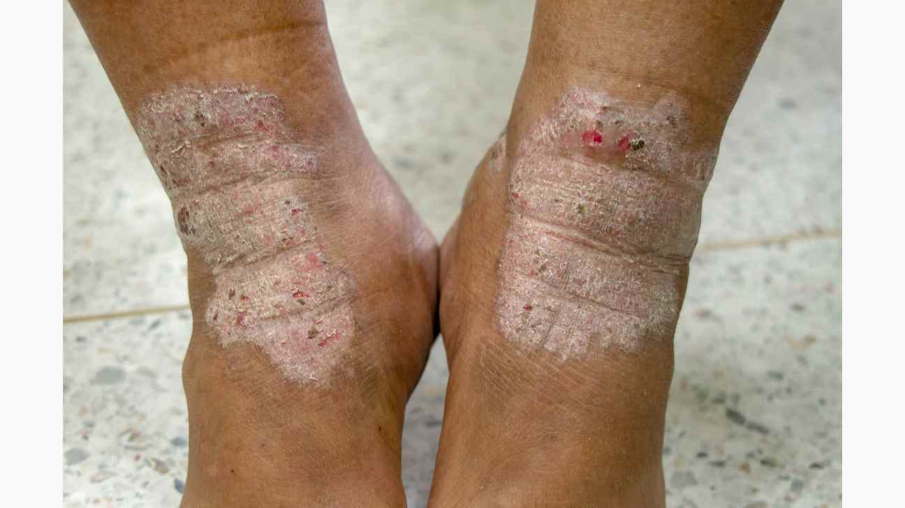 atopische Dermatitis, Ekzem