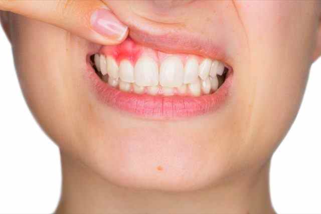 Frau zeigt mit dem Finger entzündetes oberes Zahnfleisch mit Schmerzausdruck