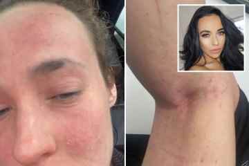 Steph Davis von Hollyoaks enthüllt „nässende Wunden“, während sich schreckliche Hautprobleme verschlimmern