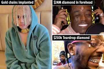 Auffällige Welt der Rapper, denen Diamanten und Goldketten auf den Kopf implantiert wurden