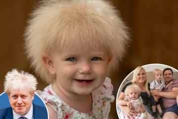 Der seltene Zustand meines Babys bedeutet, dass wir ihr Haar nicht bürsten können und sie sieht aus wie Boris