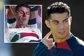 Ronaldo mit blauem Auge und Schnittwunde im Gesicht nach Verletzung während des Spiels gegen Portugal gesehen