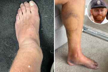 Bairstow teilt grausame Bilder von gebrochenem Bein nach einem ungewöhnlichen Unfall beim Golfspielen