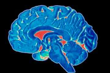 Dies sind die Anzeichen und Symptome eines Hirntumors, die Sie kennen sollten