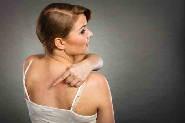 Frau, die ihren juckenden Rücken mit Allergie-Ausschlag-Urtikaria-Symptomen zeigt