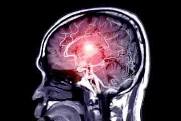 Dringende Warnung, da Bluthochdruck „das Risiko einer Brain Eating Disease erhöht“
