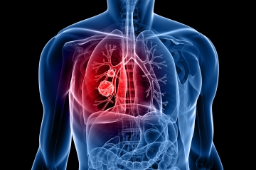 Das Symptom von Lungenkrebs, das beim Aufwachen auftritt – und 9 weitere Anzeichen
