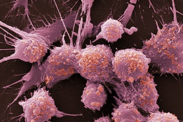 Sechs Frühwarnzeichen für eine der häufigsten Krebsarten im Vereinigten Königreich, die Sie kennen müssen