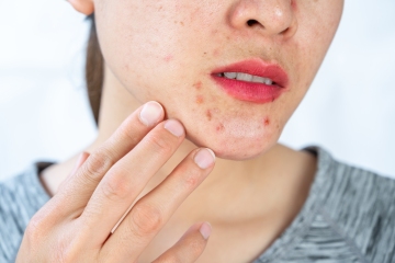 Ich bin Dermatologe – hier ist eine dreistufige Akne-Routine, die Ihrer Haut hilft, zu heilen und zu strahlen