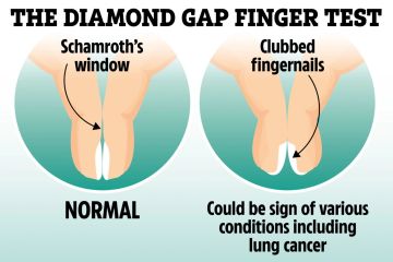 Wie einfach der „Diamond Gap“-Test zeigen kann, ob bei Ihnen das Risiko für tödlichen Lungenkrebs besteht
