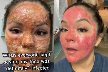 Ich habe mir eine Laser-Gesichtsbehandlung machen lassen, weil ich dachte, dass sie meine Haut wiederbeleben würde, aber die Ergebnisse waren schockierend