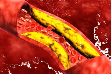 Das „stille“ Symptom eines hohen Cholesterinspiegels, das sich an Ihren ZEHEN und drei weiteren Anzeichen zeigt