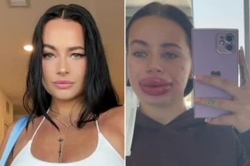 Frau verblüfft mit EXTREMEN Vorher- und Nachher-Bildern ihres Lippenfüllers