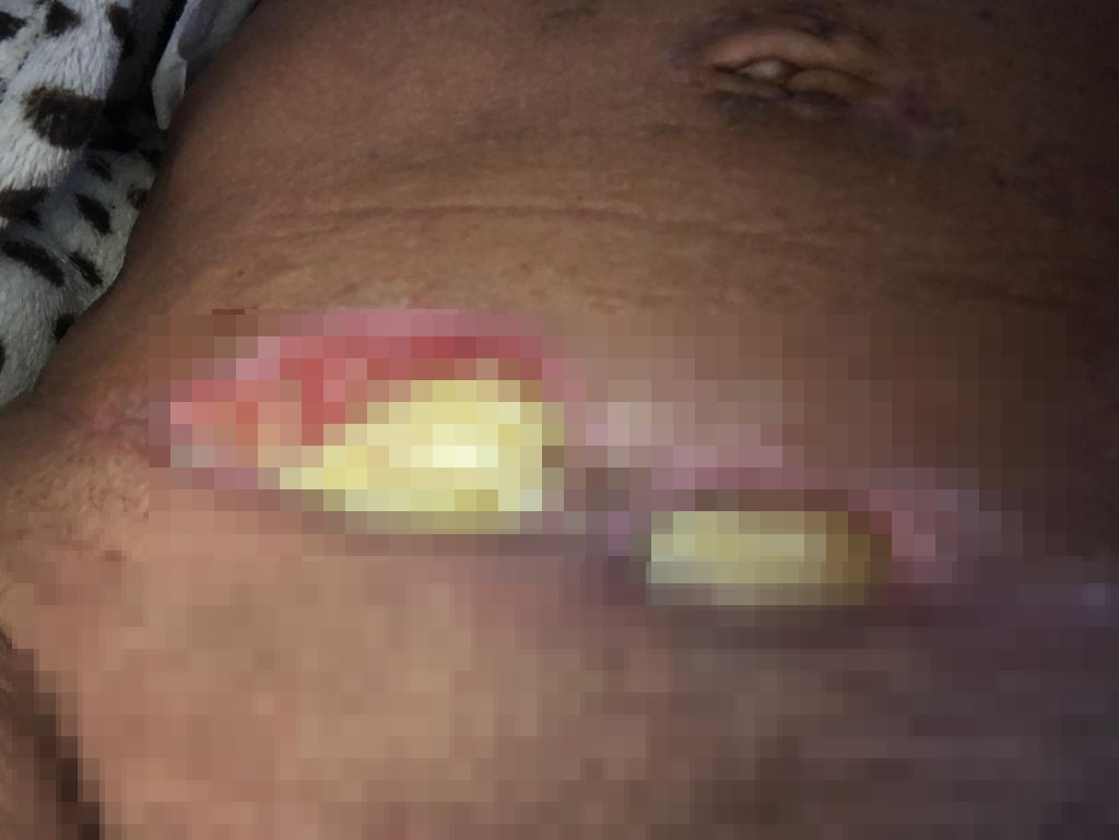 Die 61-Jährige erlitt eine fleischfressende Infektion, die langsam ihre Haut zerfraß