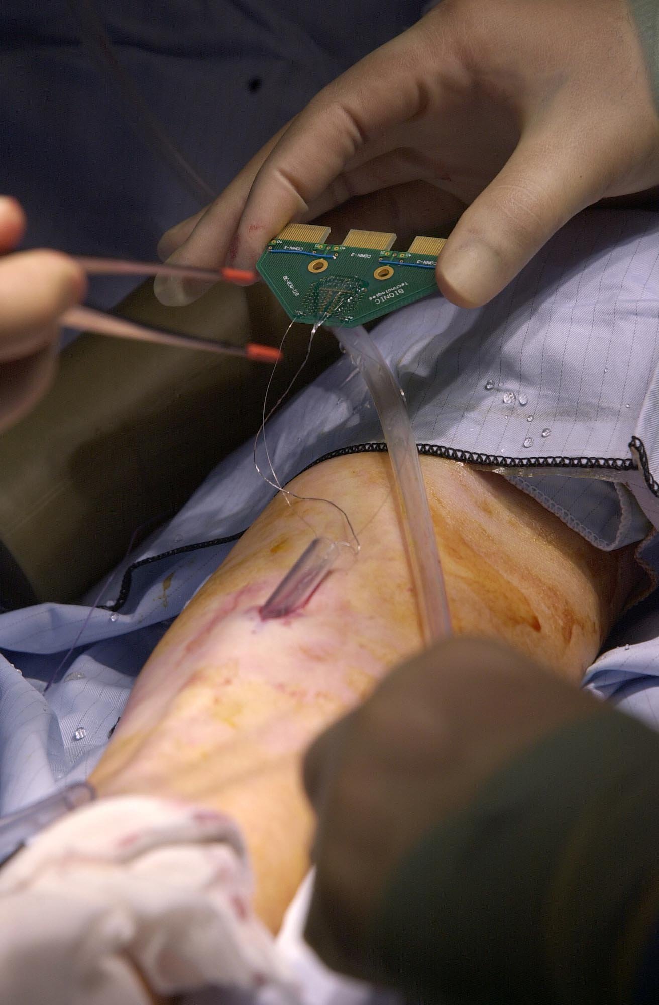 Chirurgen operierten Professor Kevin Warwick, um ihm im März 2002 einen Mikrochip in den Arm zu implantieren