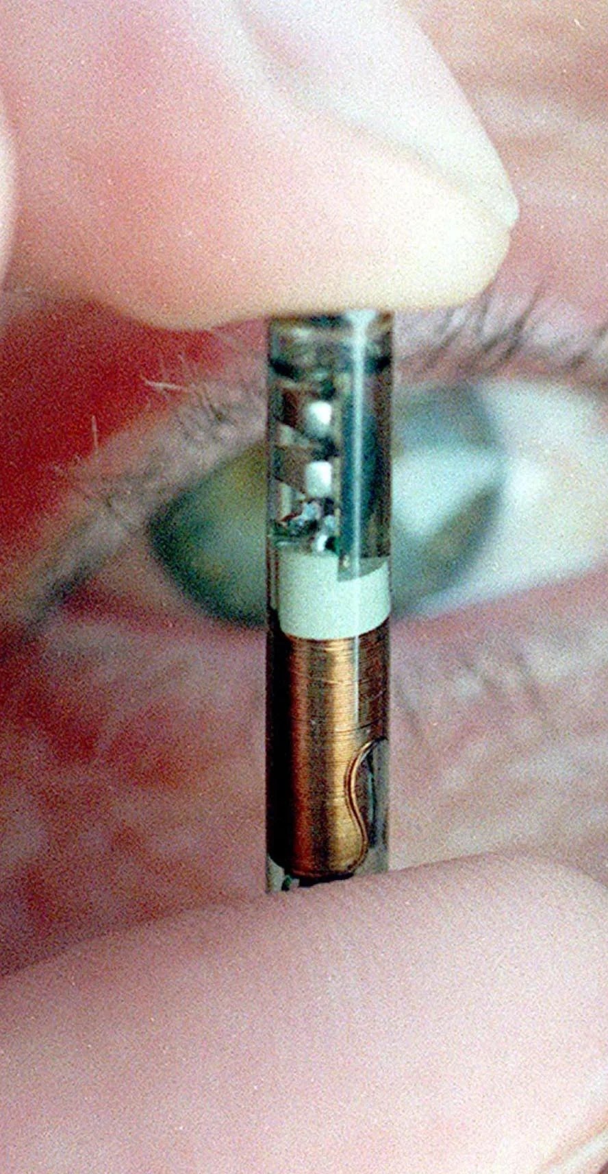 Der ursprünglich implantierte Chip bestand aus Glas und hätte zerbrechen können, wenn er zerbrochen wäre