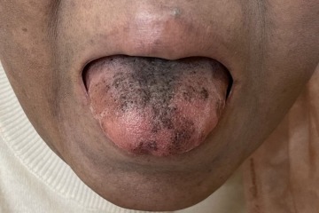 Frau blieb mit schwarzer und BEHAARTER Zunge zurück, nachdem sie auf ein herkömmliches Antibiotikum reagiert hatte