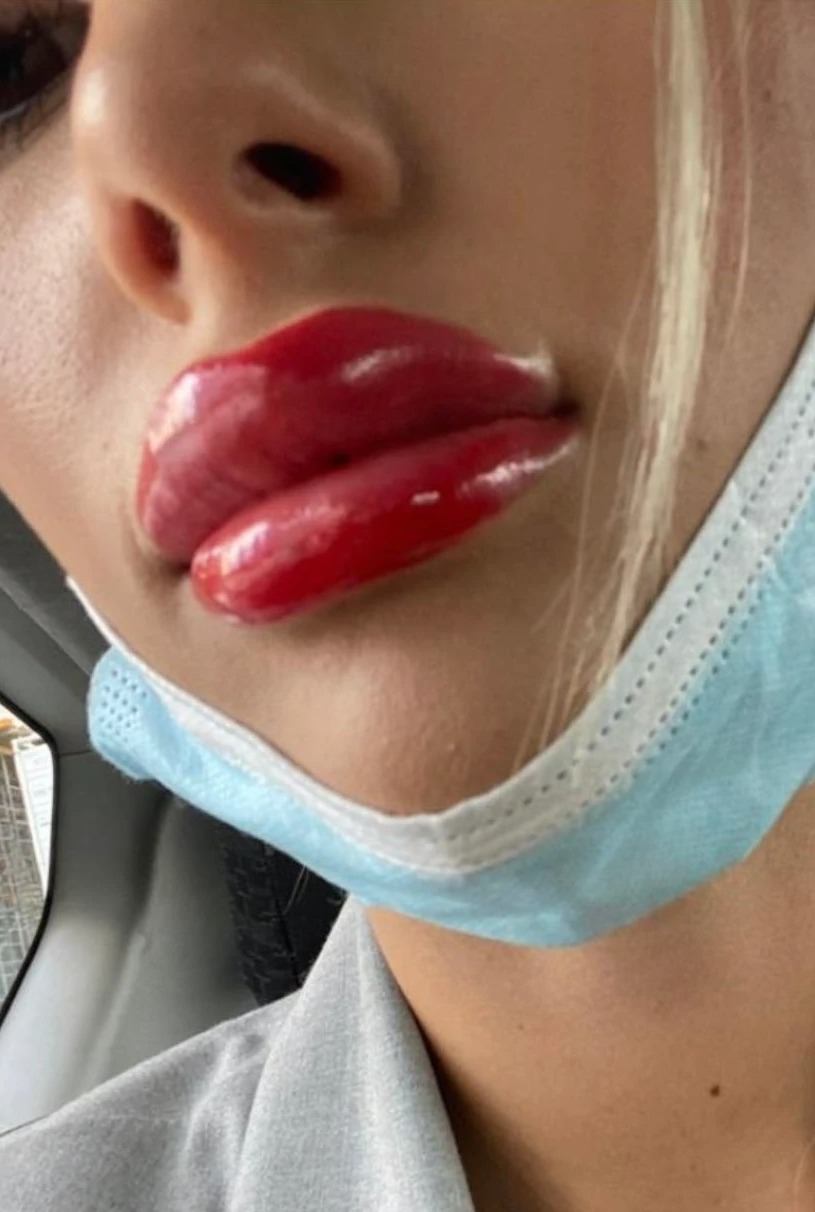 Sie entschied sich für ein 1.000 Pfund teures Verfahren zum Erröten der Lippen, sagte aber, dass sie danach wie ein „Clown“ aussah.