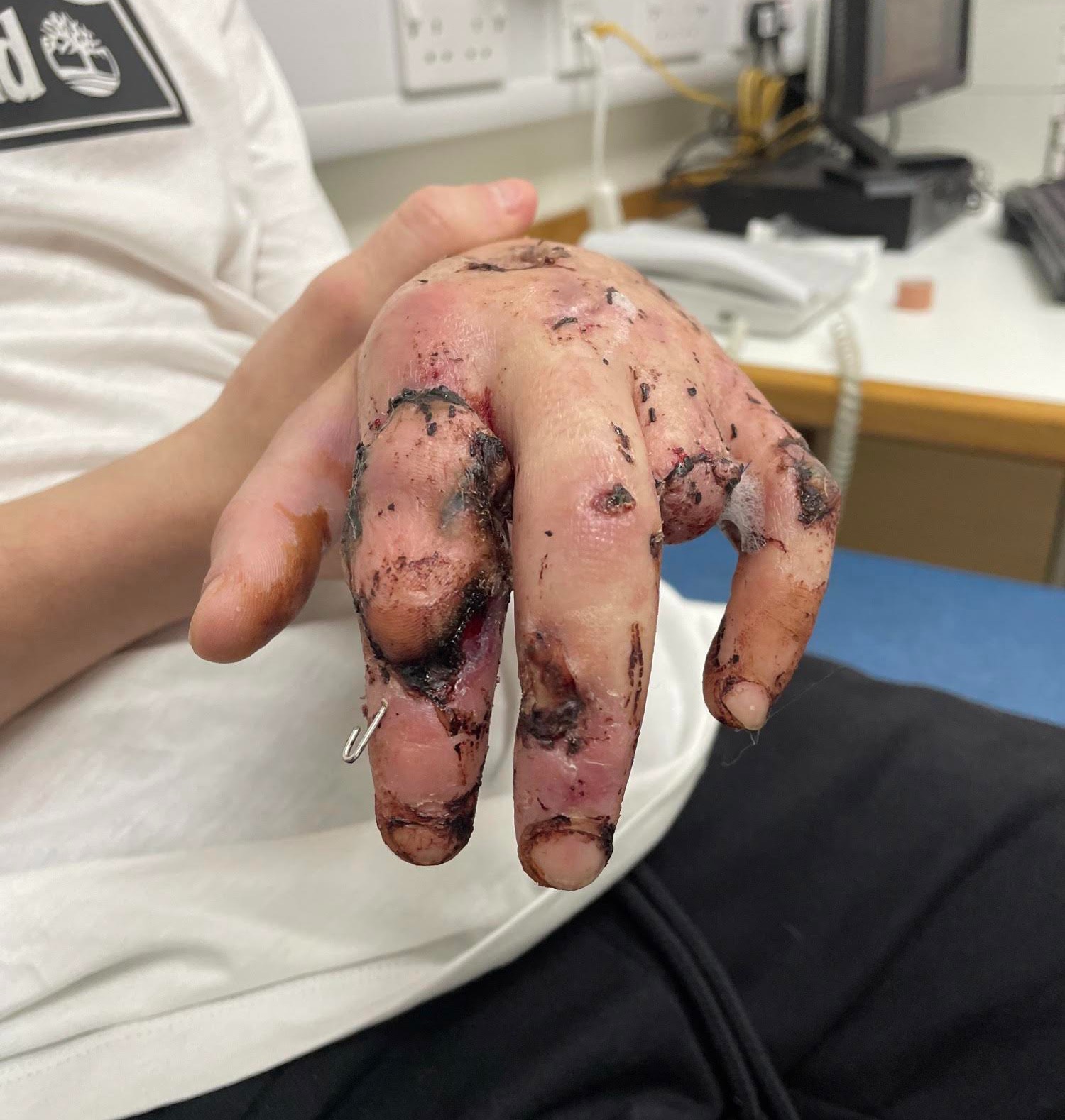 Jamies Hand nach der Amputation