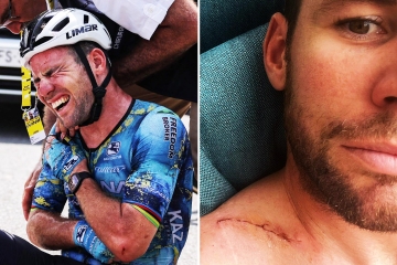 Cavendish shows off scar after crashing out of Tour de France with injury