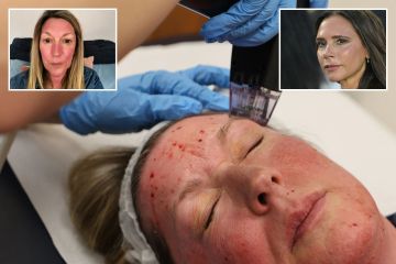Ich hatte Victoria Beckhams „schmerzhafteste“ Anti-Aging-Gesichtsbehandlung mit 24 Nadeln