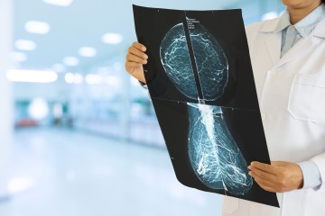 KI könnte die Wartezeiten bei Krebserkrankungen verkürzen – die Arbeitsbelastung der NHS-Mediziner wird halbiert