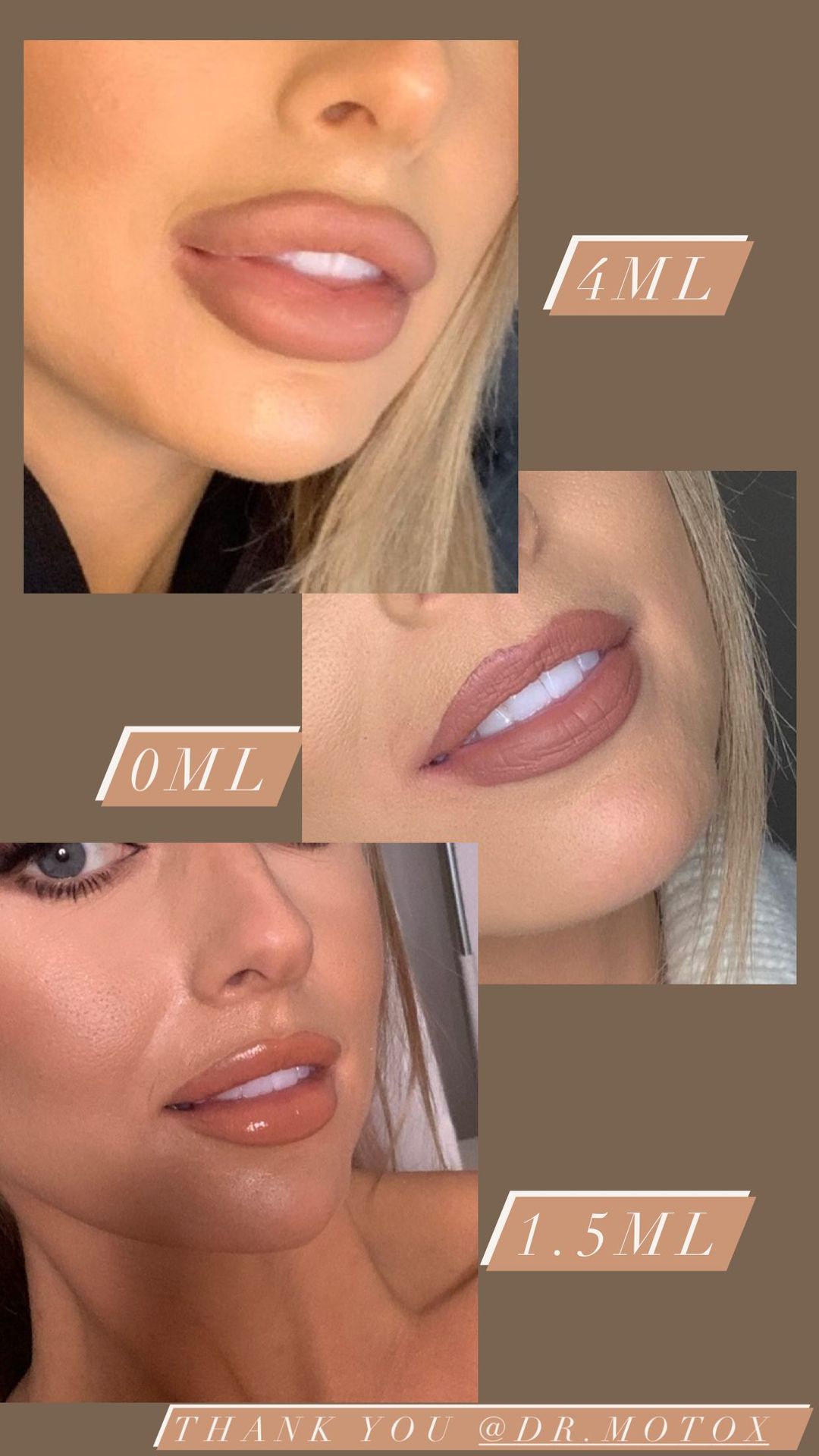Fayes Lippenverwandlung von oben (vorher) über deren Auflösung (Mitte) bis hin zu neueren Lippen mit einer geringeren Menge Füllmaterial (unten)