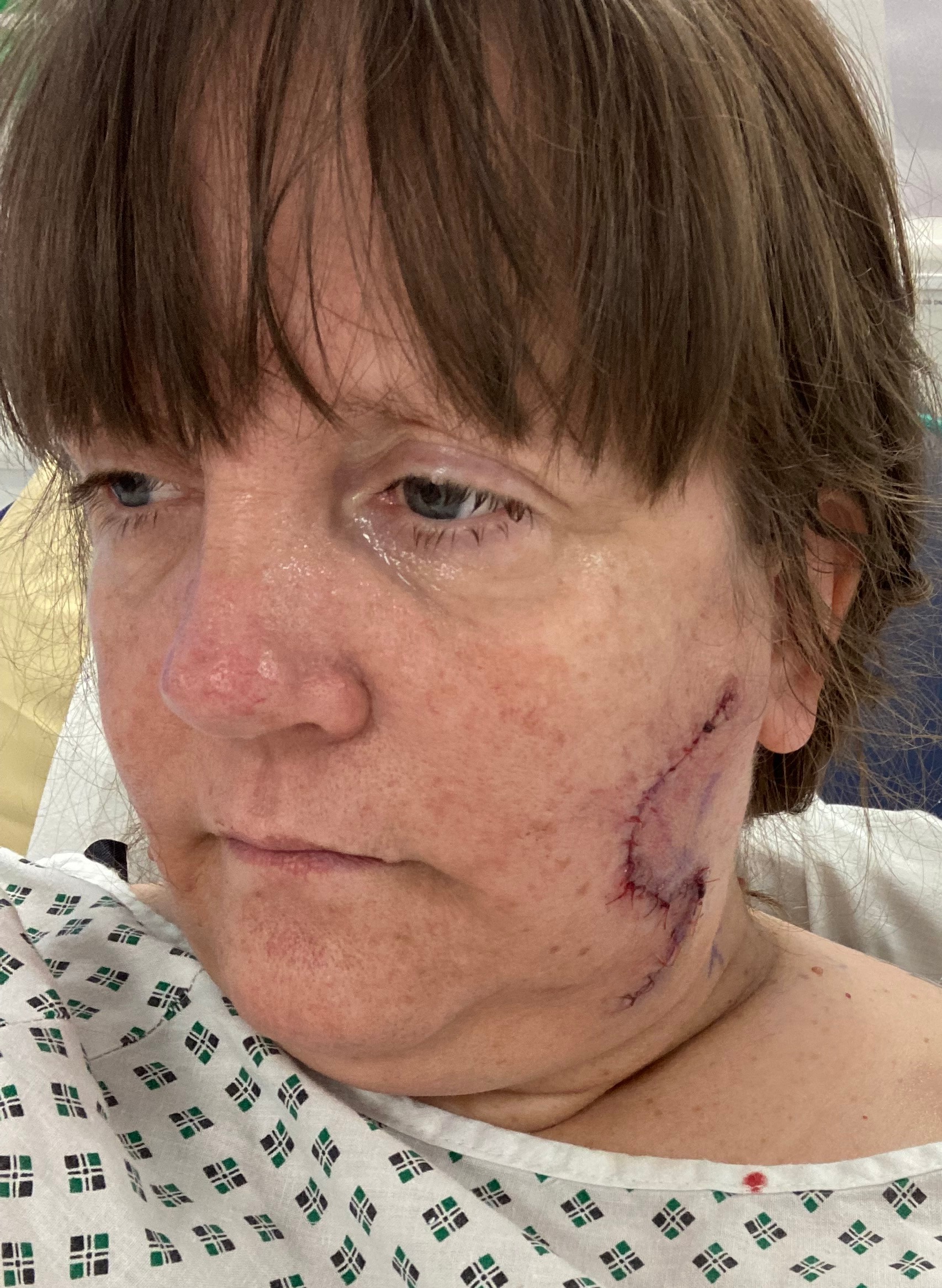 Die lebensrettende Operation hinterließ bei ihr eine riesige, gewundene Narbe an der Seite ihres Gesichts