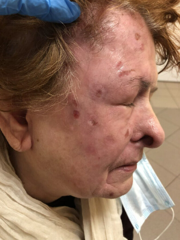 Die Ärzte behandelten sie mit betäubenden Salben und nach einem Monat begannen die Läsionen auf ihrem Gesicht allmählich zu verschwinden