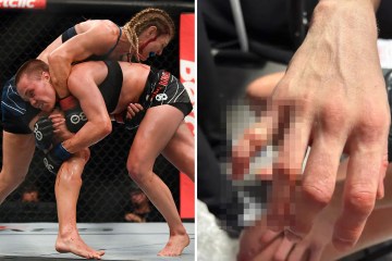 UFC-Star zeigt nach Niederlage auf groteskem Bild ausgerenkten Finger