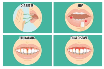 Anzeichen von Krankheiten, die IN Ihrem Mund verborgen sind – von Krebs bis HIV und wie Sie dies überprüfen können