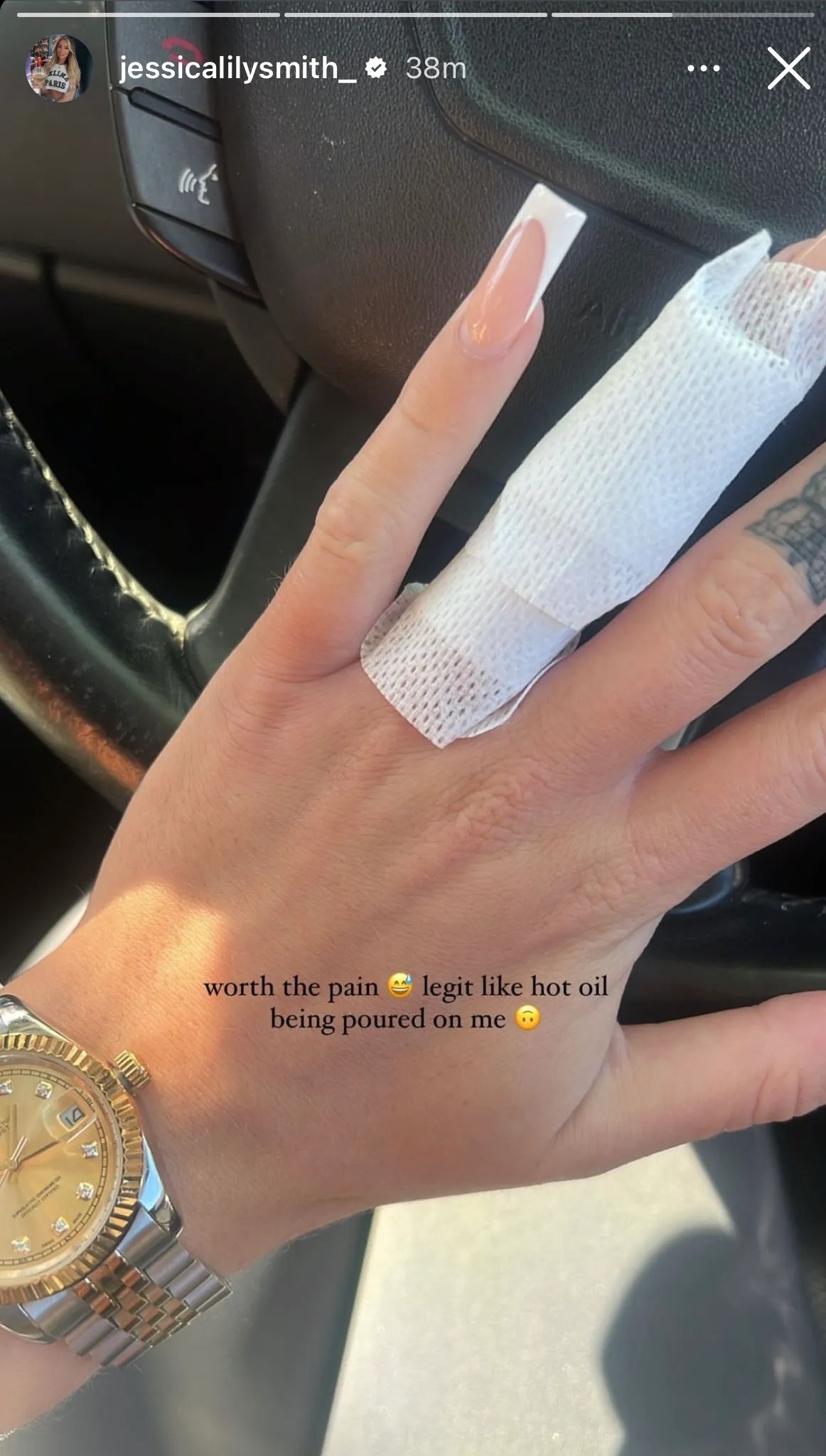Jessica ließ sich das Verlobungsring-Tattoo entfernen