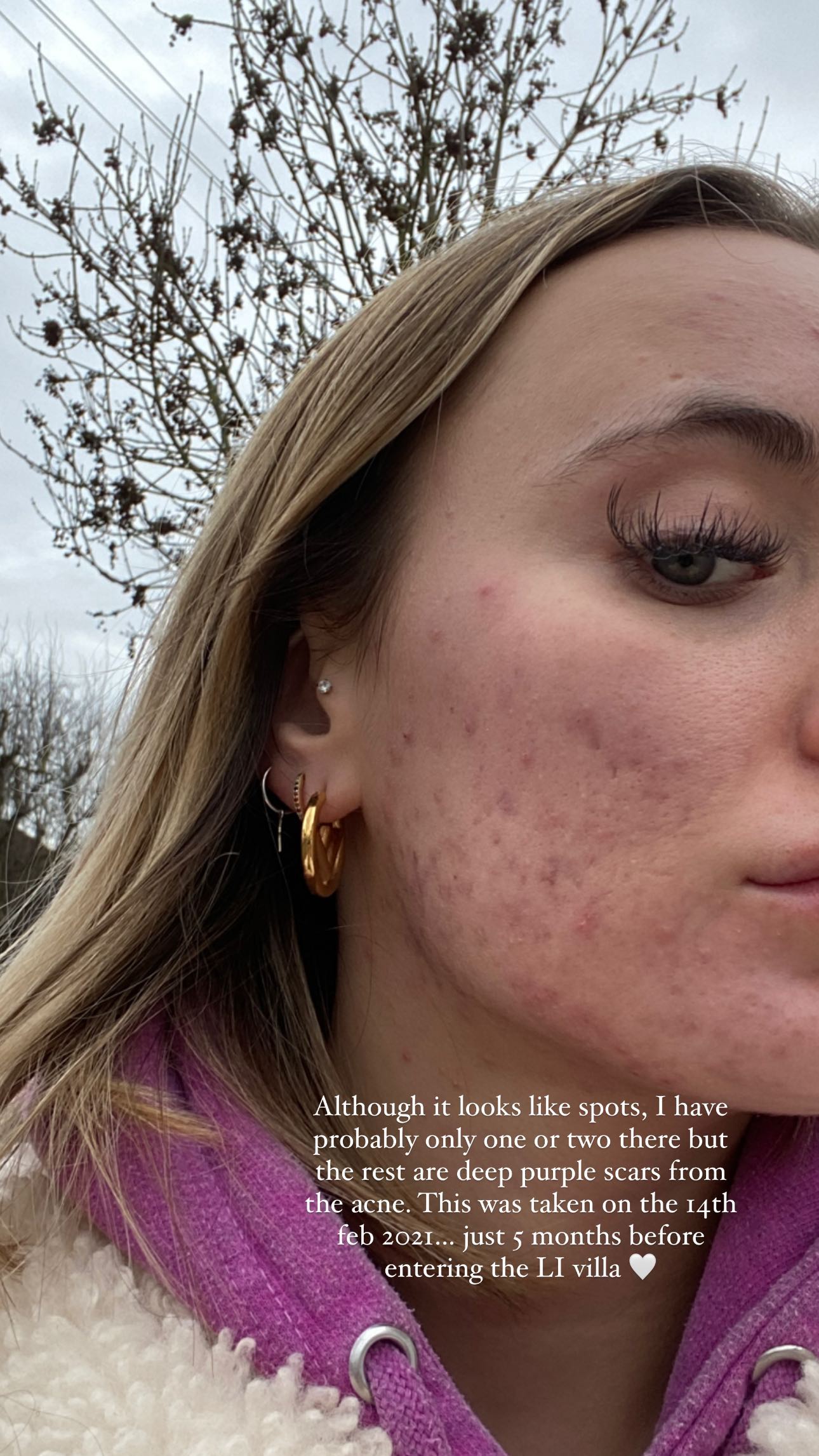 Millie, 26, äußerte sich auf Instagram immer offen zu ihrer Hautsituation