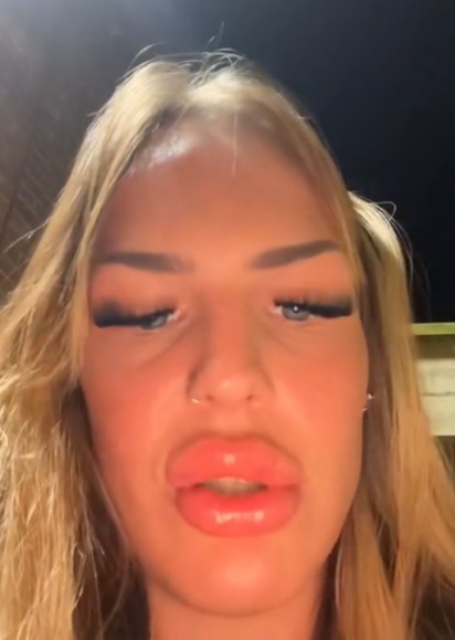 Georgia erklärte, dass sie glaubte, eine allergische Reaktion zu haben, und mit geschwollenen, schmerzenden Lippen wie eine Ente aussah