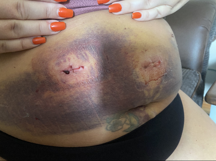 Louise's bruised stomach after the operation