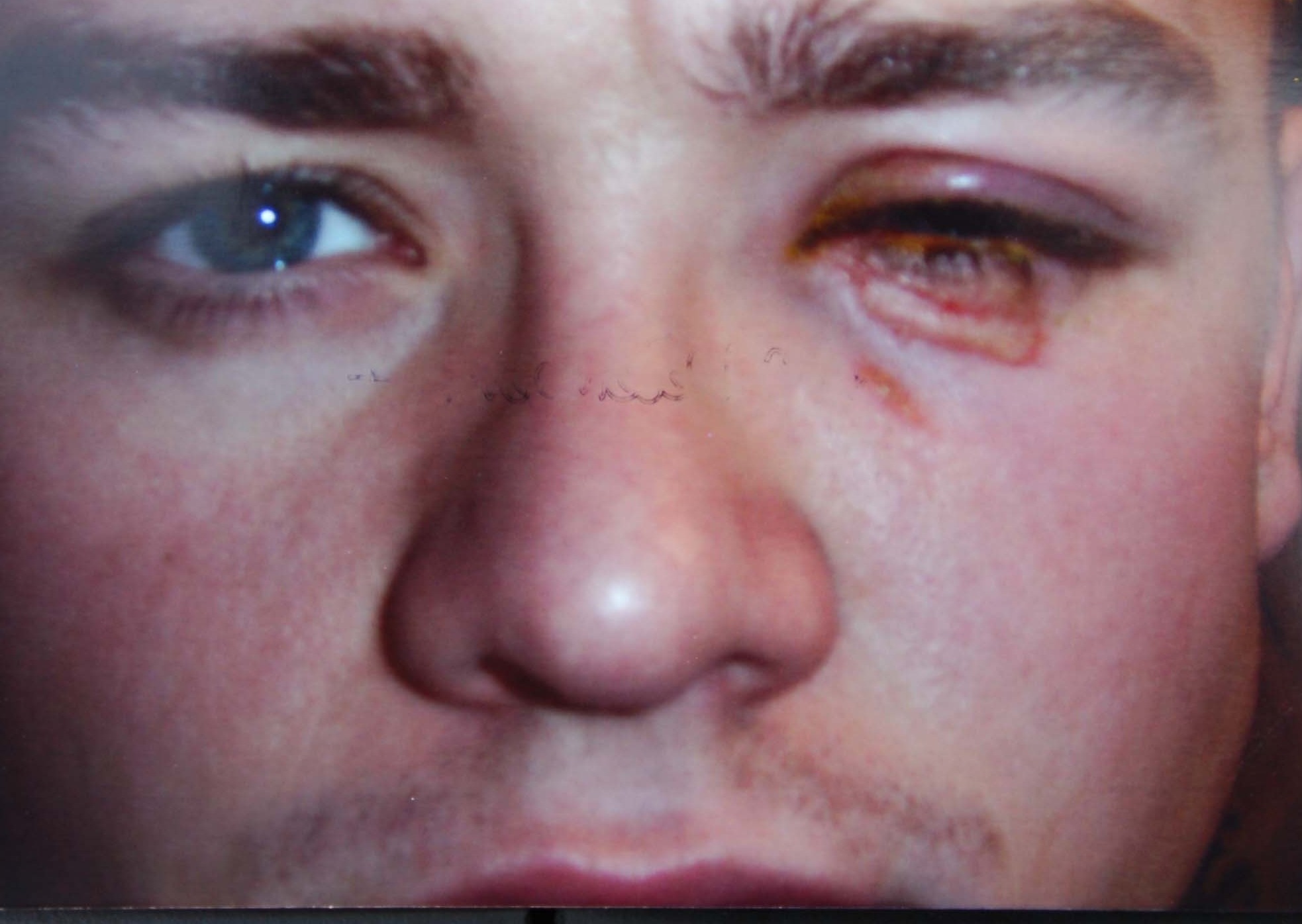 Jamie Tandys Auge wurde schwer beschädigt, nachdem Joey Barton ihn mit einer brennenden Zigarre geschlagen hatte