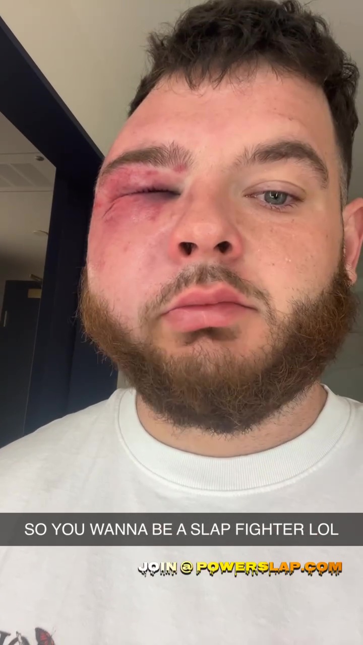 Turpin erlitt nach der Niederlage gegen Ron Bata ein geschwollenes Auge und schwere Blutergüsse im Gesicht