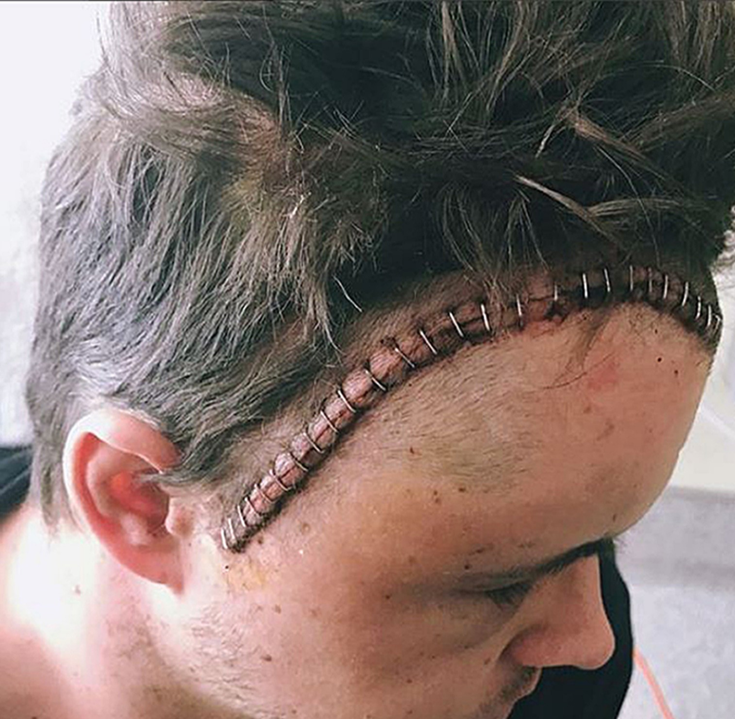 Ruffo forderte die Fans nach der Operation in einem Instagram-Update auf, „im Kopf an ihn zu denken“.