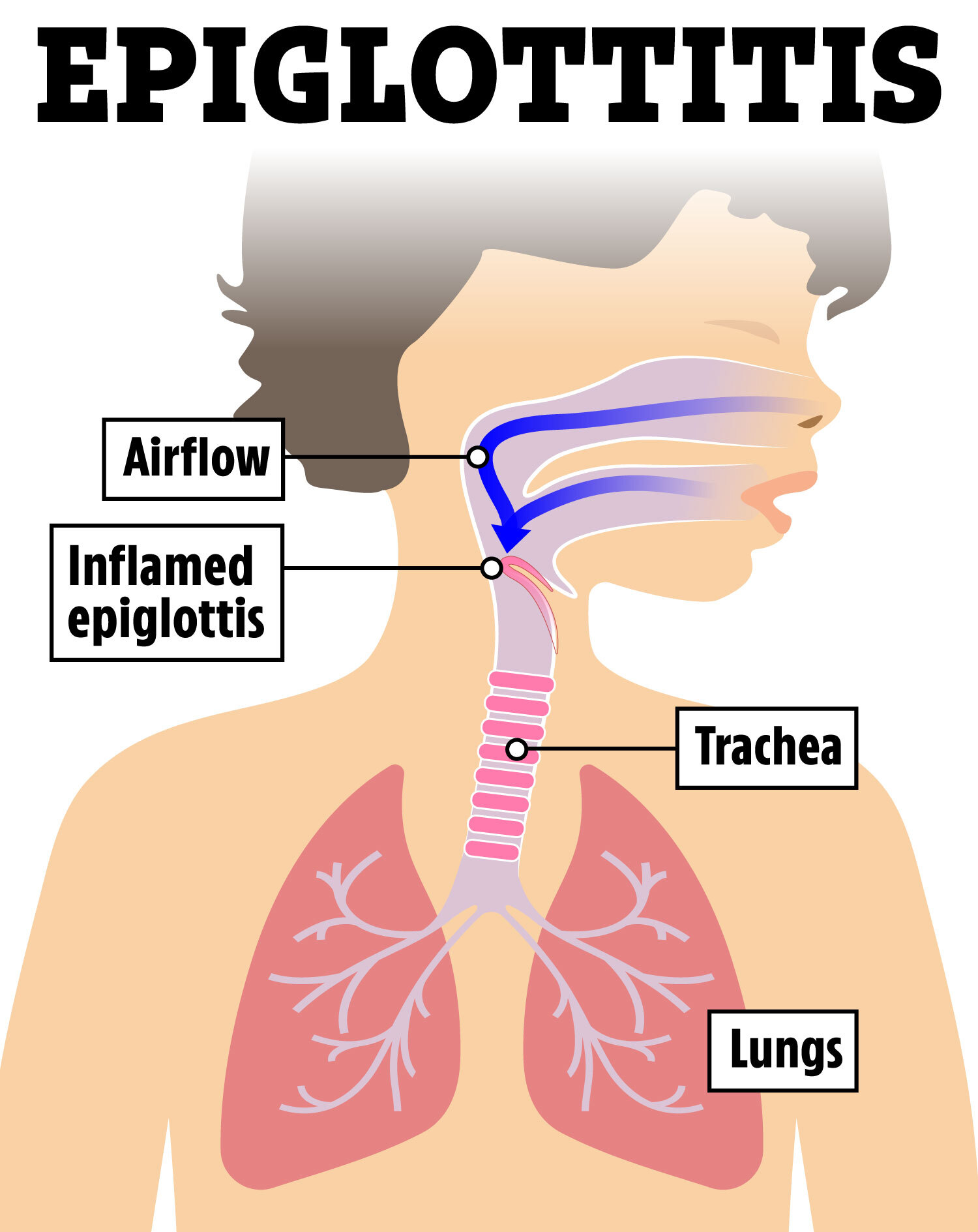 Wie sich eine Epiglottitis auf die Atemwege auswirkt
