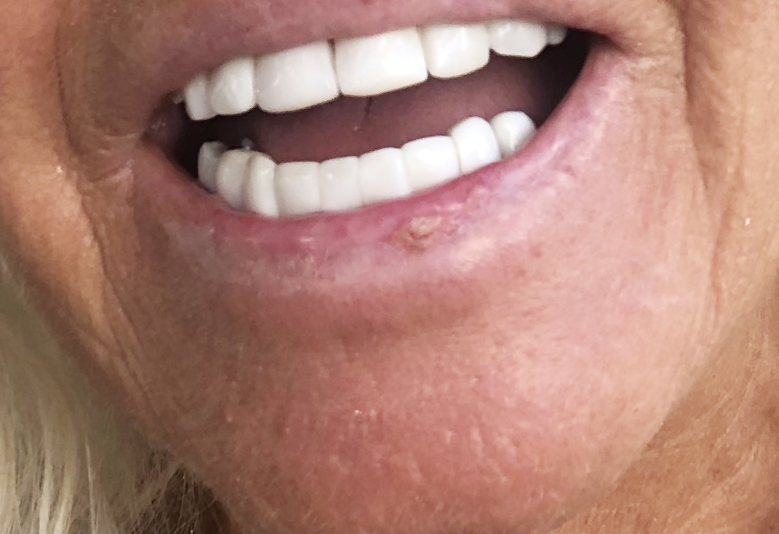 Pauline thought the dry spot lingering on her lip was a cold sore - but a biopsy revealed she has squamous cell carcinoma, which doctors claimed could have been caused by lip filler