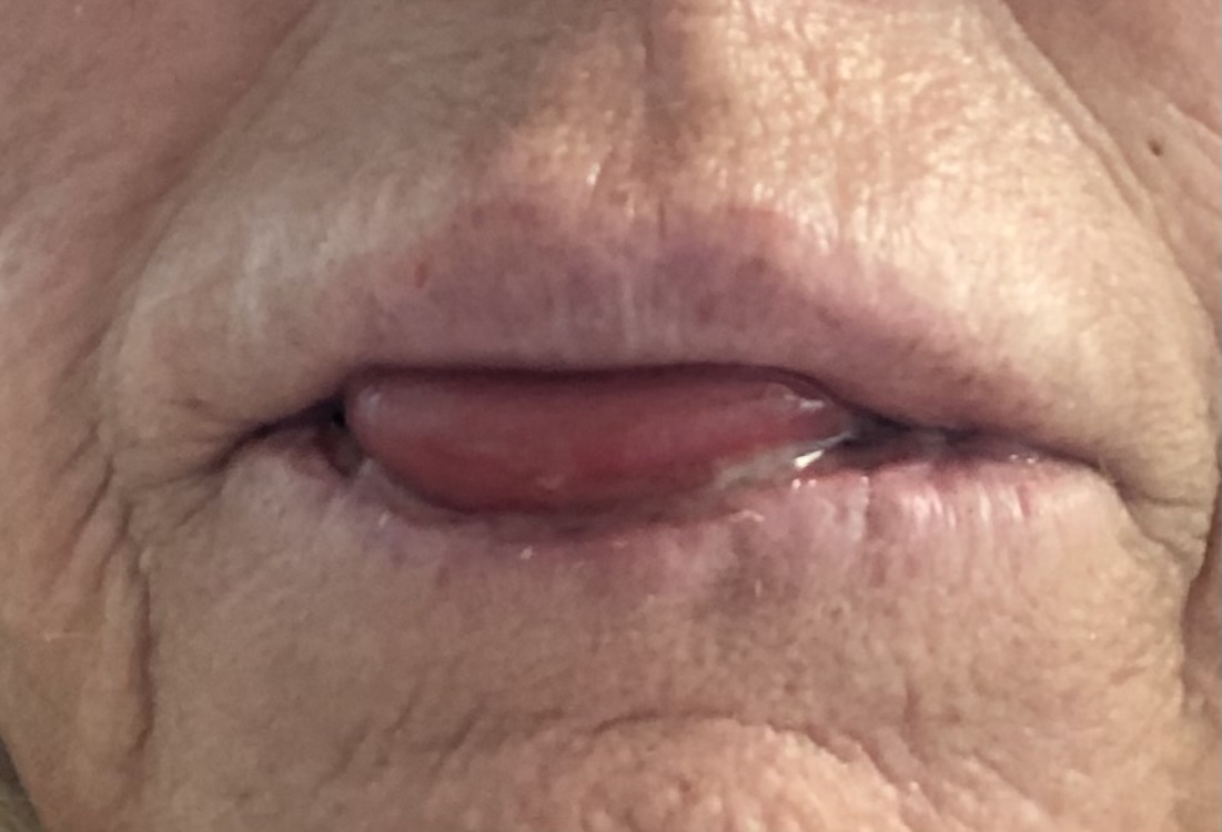 Pauline underwent surgery where her tumour was removed and tongue sewn to her lips - this picture was taken shortly before her tongue was severed to create a new bottom lip