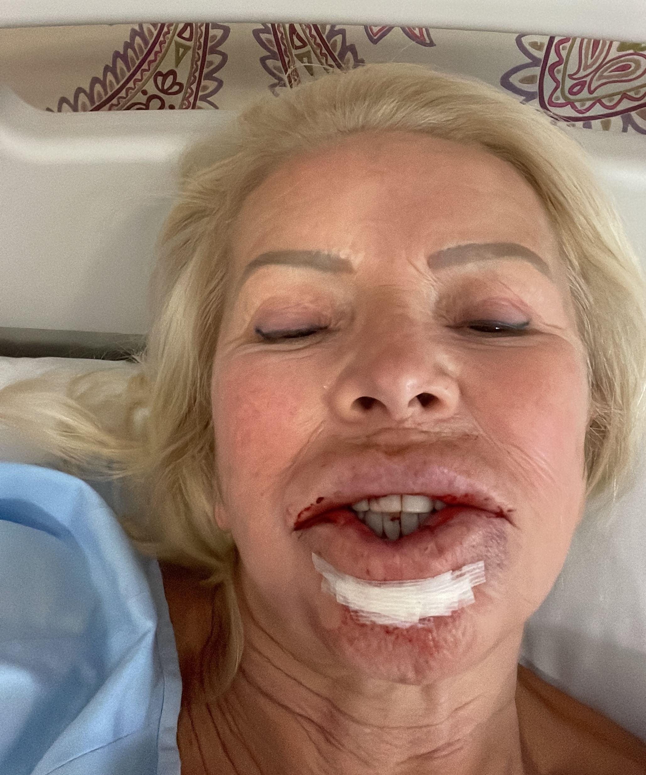 Pauline then underwent a number of procedures to reconstruct her lower lip, including having fat and dermis from her breast injected into it