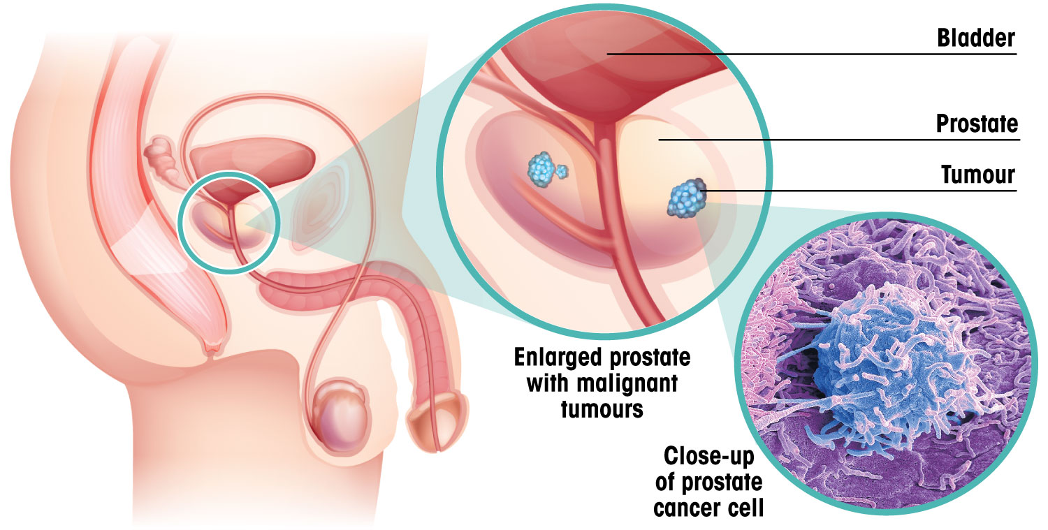 Wie Prostatakrebs aussieht