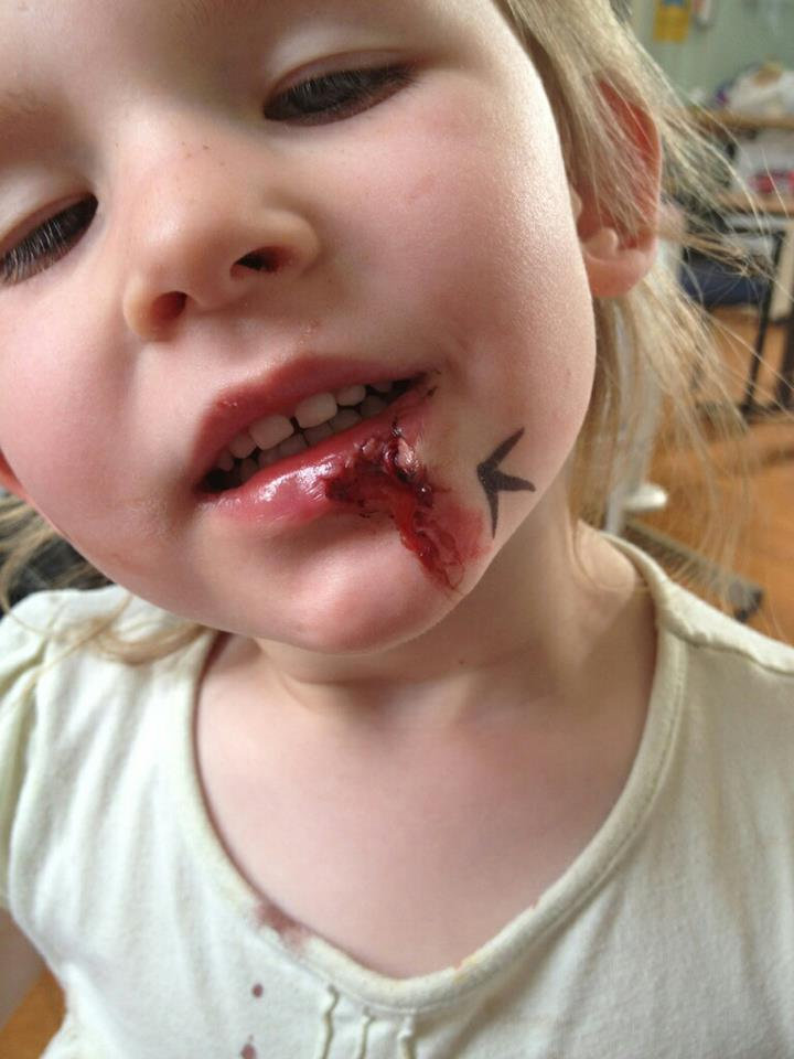 Olivia musste operiert werden, nachdem sie ihre Lippe schwer verletzt hatte